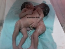 Nouakchott: Naissance de deux jumelles collées au niveau du thorax Nouakchott: Naissance de deux jumelles collées au niveau du thorax