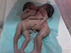 Nouakchott: Naissance de deux jumelles collées au niveau du thorax