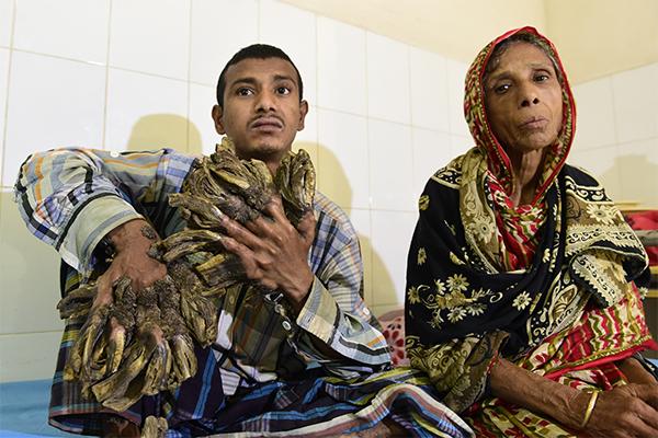 Bangladesh : "l'homme-arbre" va bientôt être opéré