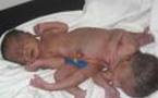 CHN de Nouakchott :Naissance de deux jumeaux siamois avec deux tetes et trois pieds