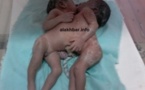 Nouakchott: Naissance de deux jumelles collées au niveau du thorax